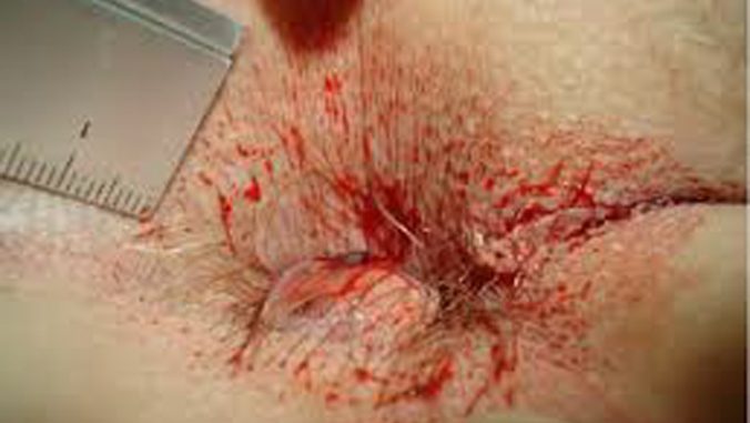 Hemorrhoids are enlarged blood vessels in the lower rectum and the anal. It is also known as "Piles". It causes pain and irritation in the rectum. But, it is more painful when thrombosed hemorrhoid burst. Therefore, after knowing the ins and out of what is a thrombosed hemorrhoid burst, it is very essential to take proper treatment. Many people do not feel any pain or irritation in normal hemorrhoids. But the embarrassment is created when the hemorrhoids are burst. When the hemorrhoids are burst, it bleeds for less than 10 minutes. But sometimes, it produces a lot of blood. There is an upside to broke hemorrhoids. The broke hemorrhoids greatly lessen the pain for most of the people. What are thrombosed hemorrhoids? People's anal line is connected with blood vessels. The hemorrhoids are created when the blood vessels are expanded or swollen. Hemorrhoids can be created in the internal or external part of the anal. When the internal hemorrhoids or external hemorrhoids are filled with blood clots, it occurs thrombosed hemorrhoids. The word "thrombose" meaning is clotting. It causes trouble and pain. It also produces a lot of blood. It causes problems when hemorrhoids are swollen. It causes pain and itching around the outside of the anus. It can make entrails movement dismal and uncomfortable. Symptoms of Thrombosed Hemorrhoids: Thrombosed external hemorrhoids or thrombosed internal hemorrhoids both produce pain and swollen. The symptoms of thrombosed hemorrhoids are given below: • Feeling pain when sitting, walking, or going to the toilet to throw out the evacuation. • Feel itching around the rectum. • Produce blood when throwing out the evacuation. • Swelling around the rectum. • Felling pain in guts movement. For thrombosed hemorrhoids, it feeling fever with pain. It also creates infection around the surroundings of the rectum. This infection is called absence. Causes of thrombosed hemorrhoids: Hemorrhoids are related to a person's diet. It is also a symptom of underlying health anxiety. When increased pressure is put on the vessel of the rectum, it may develop hemorrhoids. The causes of these include: • Diarrhea • Irregular guts movement • In train, car, or plane trip sitting for a long period. • Constipation • Feeling too hard when trying to throw out a stool • In the pregnancy, the force of the baby pressing or during delivery pressing on the veins • Do not go to the toilet regularly. Doctors also do not know why blood clots produce in the rectum. The particular things can raise the risk of producing hemorrhoids, include: • Pregnancy • Constipation may cause for not eating enough fiber food • Sitting one place for a long period • With the increasing age of a person, the tissue becomes weaker Treatment of Thrombosed Hemorrhoids: The procedure of the thrombosed hemorrhoids treatment is called a Thrombectomy. It is a small procedure of treatment where doctors make a cut in the hemorrhoids clot and drain the blood. This treatment works best within a few days after the blood clots turn into the hemorrhoids. You may feel pain after the treatment. There is a difference between the treatments. The various treatments include: • Hemorrhoidectomy: This procedure for remove hemorrhoids including the blood vessels and clots as surgery. The procedure will be done under the general anesthetic. This procedure is more invasive than other options. The most severe hemorrhoids cause much more pain. The procedure is only done for acute hemorrhoids. When the surgery is completed, it produces pain, urinary infections, and trouble emptying in a bladder. • Rubber Band Ligation: An elastic band is set around the base of the hemorrhoids under the doctor's observation. After some weeks, it stops the blood supply, and hemorrhoids should shrink. • Stapled Hemorrhoidopexy: This procedure is a stapling instrument to set in the hemorrhoids place. This is done in the sleeping condition under general anesthetic. There also have some thrombosed hemorrhoid home treatments to lessen pain and trouble. The following treatments are: • Use an over-the-counter hemorrhoids ointment or cream. It can soothe hemorrhoids symptoms. • To relieve pain, take an over-the-counter pain reliever. • Sit in a warm bath or soak the affected area many times in a day three or four times • Use ice packs or a cold compress over the affected area. It may reduce pain. • Use pure aloe vera at the affected place to lessen inflammation. • Wet wipes help to reduce less irritation and friction in the affected area rather than toilet papers. • Use witch hazel to reduce itching and pain in the affected area. • Take fiber supplements or stool softener at home for thrombosed hemorrhoids treatment. Prevention of Thrombosed Hemorrhoids: It is not sure that will a thrombosed hemorrhoid go away permanently. But some tricks to prevent hemorrhoid include: • Eat high fiber foods like broccoli, whole-wheat pasta, oatmeal, and bran flakes. Fiber helps to make stool soft and keeps bowel movement regular. • Do exercise regularly. Avoid sitting for a long period. Walk regularly around every hour. It helps the bowel movement and prevents hemorrhoids. • Drink water is good for health. Always drink around 8 glasses of water in a day. It keeps hydrate the body and helps to lessen constipation and the straining. • Regular go to the toilet. It can help to restrain hemorrhoids and constipation. If you feel constipation, do not push excessively. It will be best to take the stool softener. The thrombosed hemorrhoids healing time is seven to ten days without any surgery. It should shrink in a week if it regular hemorrhoids. But if you feel healing, you should avoid all laborious activities and severe exercise. At last, if the thrombosed hemorrhoids are untreated, it can feel uncomfortable, painful, itchy, and stool too hard when it passes. But it can prevent by home remedies when the symptoms of hemorrhoids can feel or see. In some cases, if it is treated, the thrombosed hemorrhoids burst can produce the problem. It is more painful and uncomfortable than regular hemorrhoids. So, take medical treatment if you feel the symptoms of hemorrhoids. If you need the surgery, it will be done under the general anesthetic. The treatments of the thrombosed hemorrhoid burst are generally effective and fruitful.
