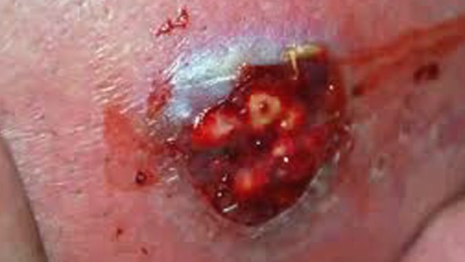 thrombosed hemorrhoid burst